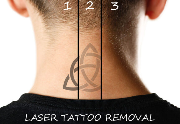 Advanced Laser Tattoo Removal is available at New Skin Medical in Augusta GA