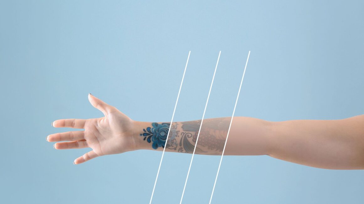 Laser Tattoo Removal