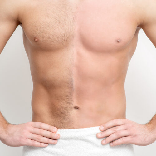 New Skin Medical now offers Motus Ax Laser Hair Removal is now available for men and women desiring a pain-free laser hair removal treatment