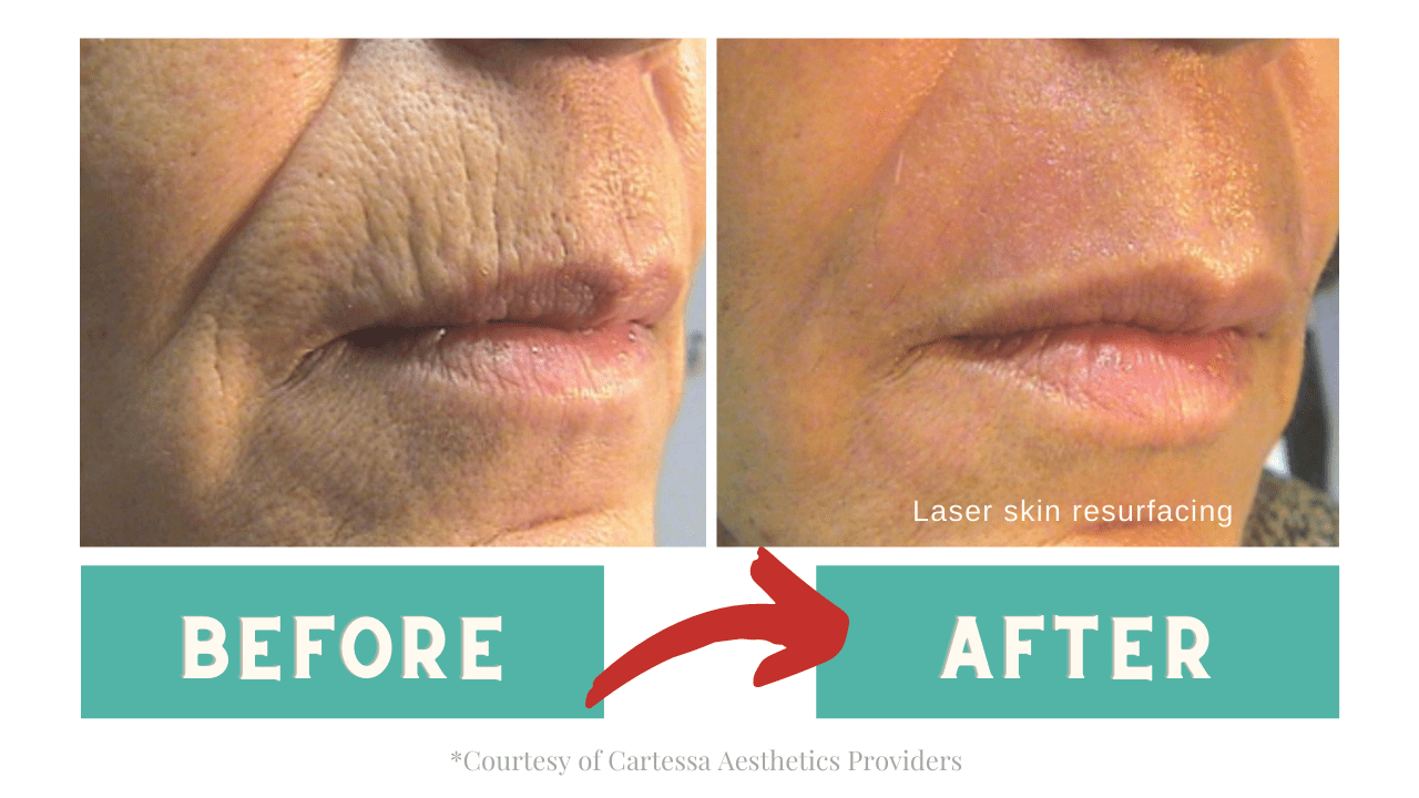 Before and after skin resurfacing