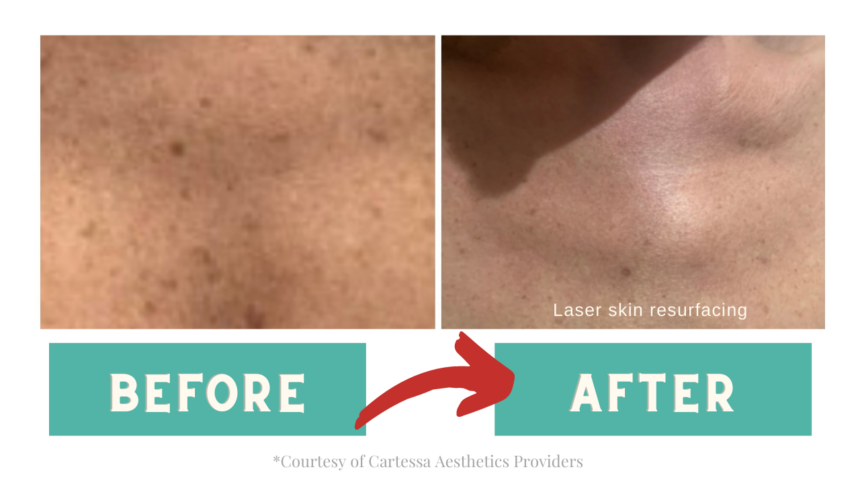 Before and after CoolPeel Laser Treatments