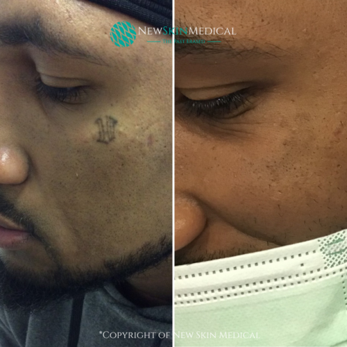 Before and after 3 laser tattoo removal treatments by Dr. James C. Sherman 