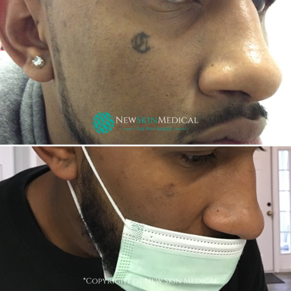 Advanced Laser Tattoo Removal by Dr. Sherman 3 sessions