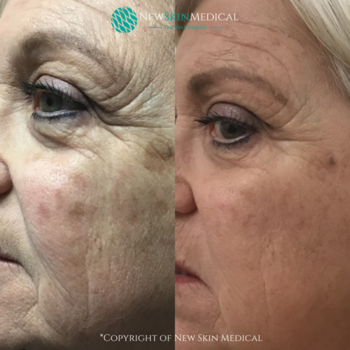 Before and after PicoGenesis