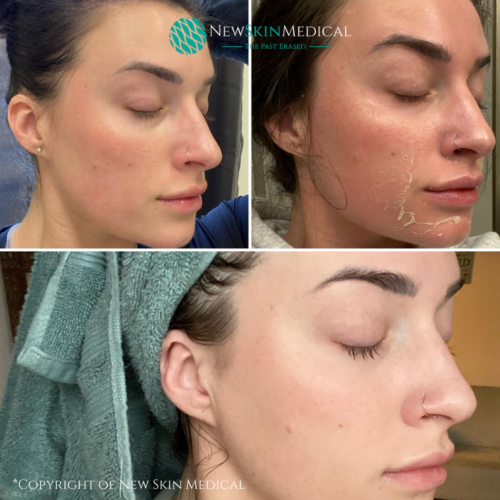 Real patient before and after 1 Vi Peel to refresh skin and reduce redness - Image Copyright of New Skin Medical Spa