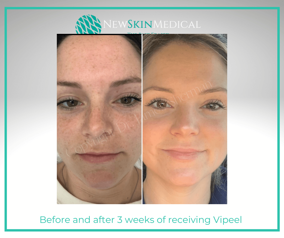 Before and after 3 weeks of receiving Vipeel by our Esthetician Sarah- New Skin Medical Augusta