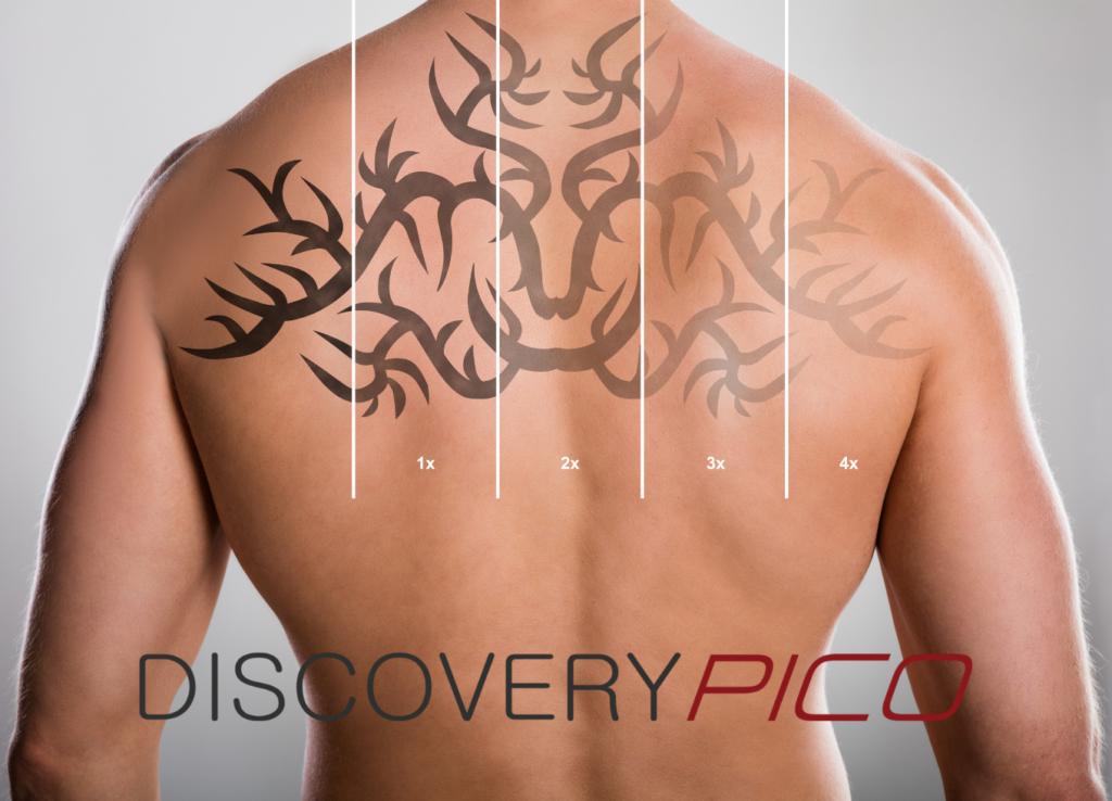 Discovery-Pico-Laser-Tattoo-Removal-Treatment