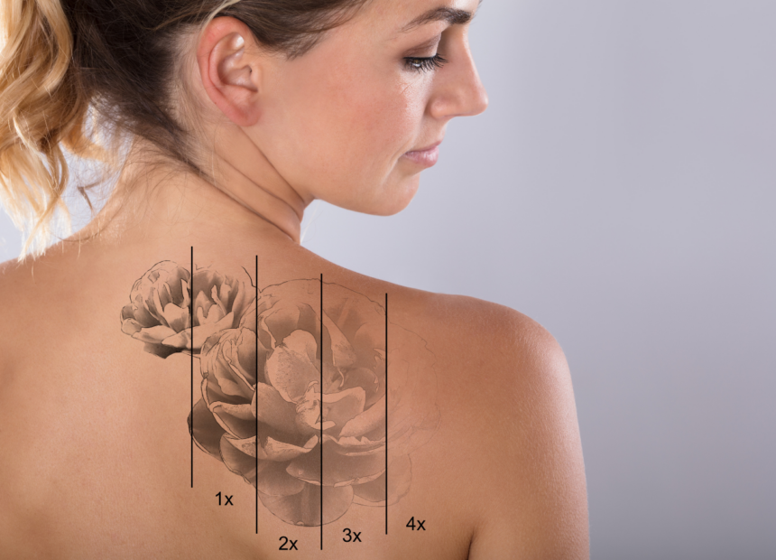 Experience the latest in Laser Tattoo Removal 