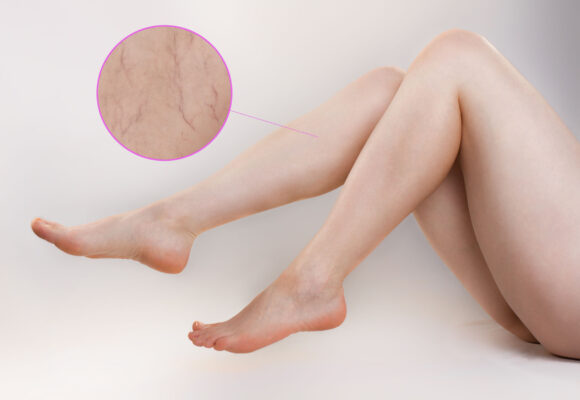 Spider Vein Treatment Consultation - Spider Vein treatments at at Vein Specialists of Augusta, a sister company of New Skin Medical Spa