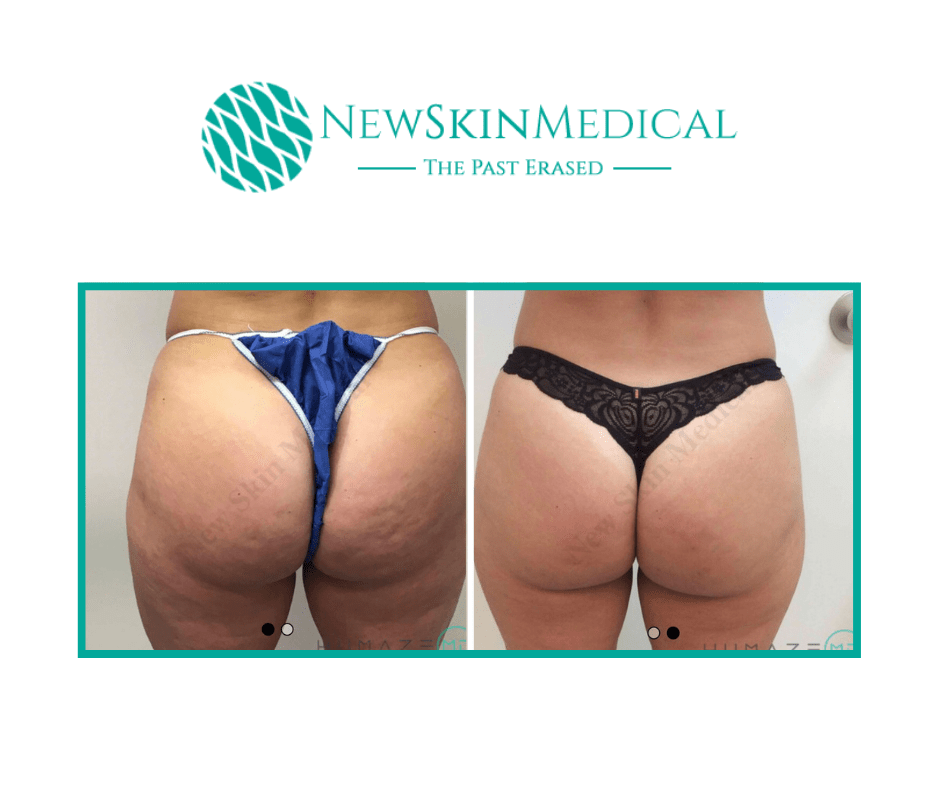 Cellfina the #1 Cellulite Treatment FDA cleared to last up to 3 years