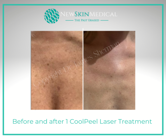 Before and after 1 CoolPeel Laser Treatment