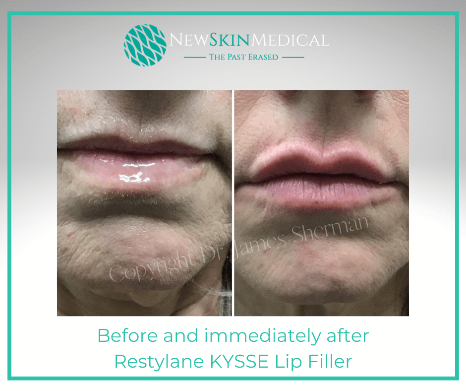 Before and After Restylane KYSSE For Lips with Dr. James Sherman