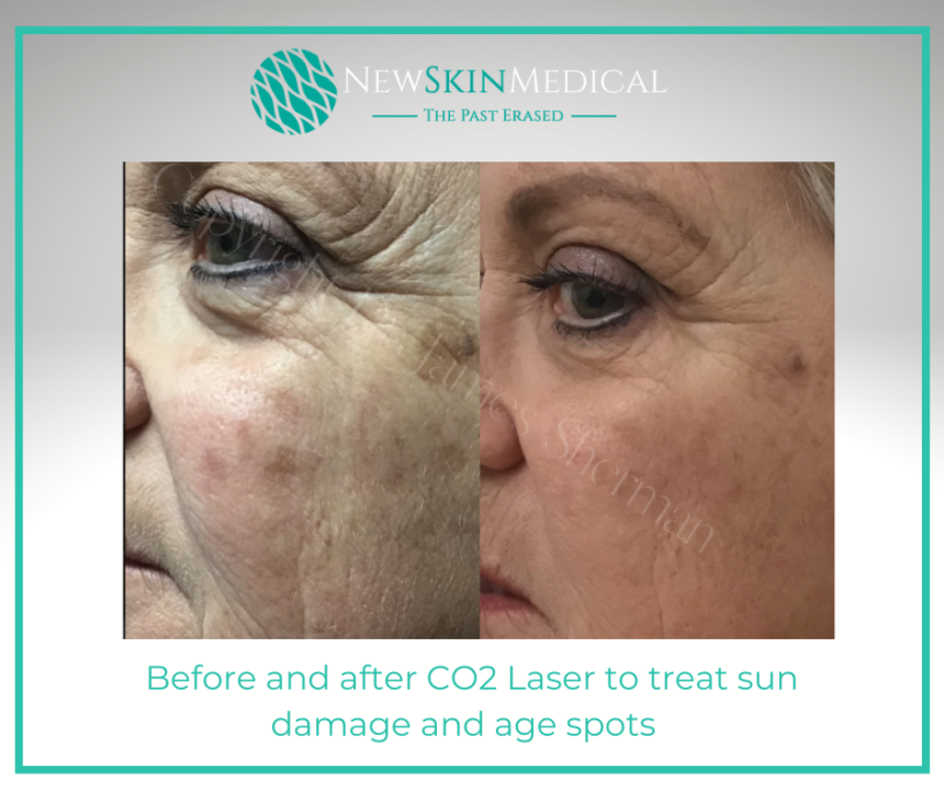 Before and after CoolPeel Laser 