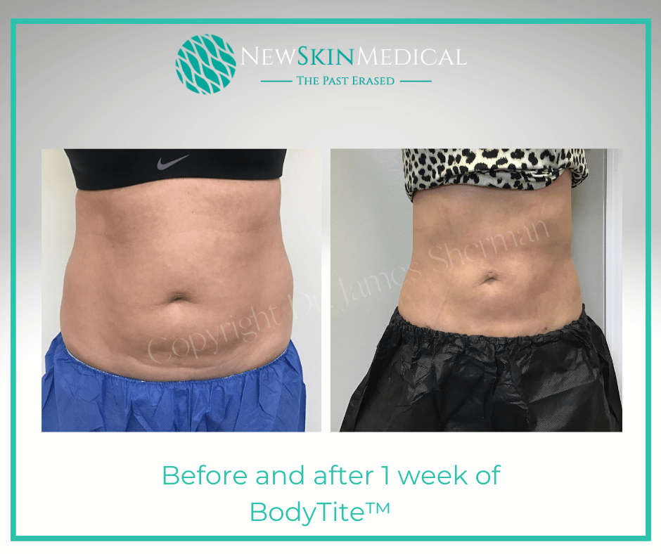 Before and after 1 week of BodyTite