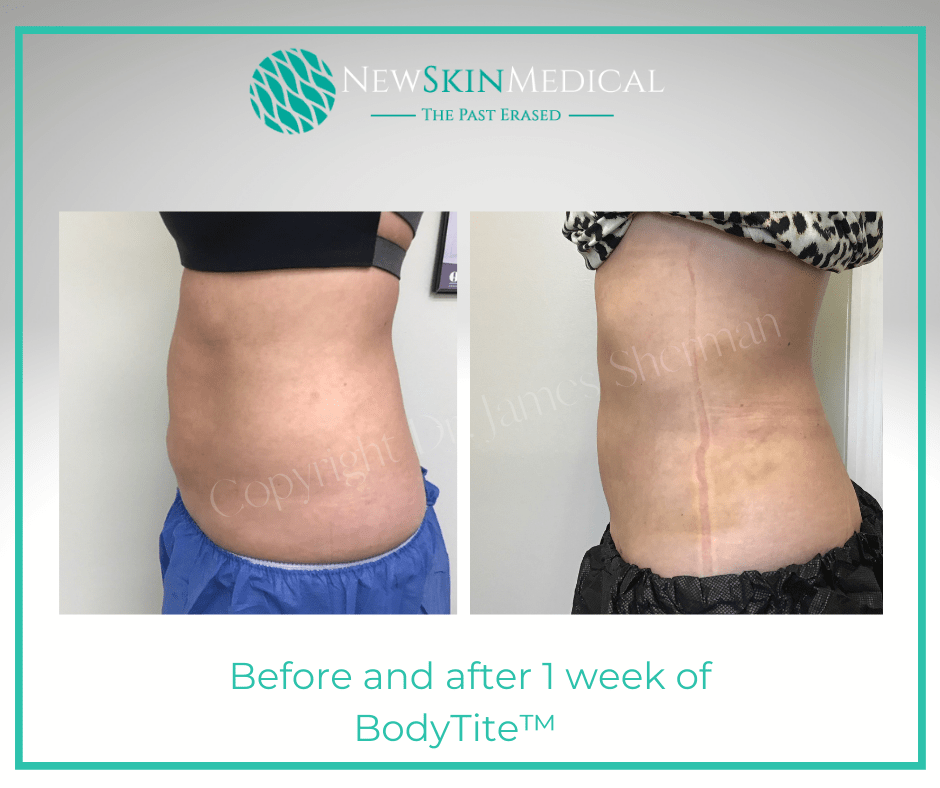 Before and after 1 Week of BodyTite