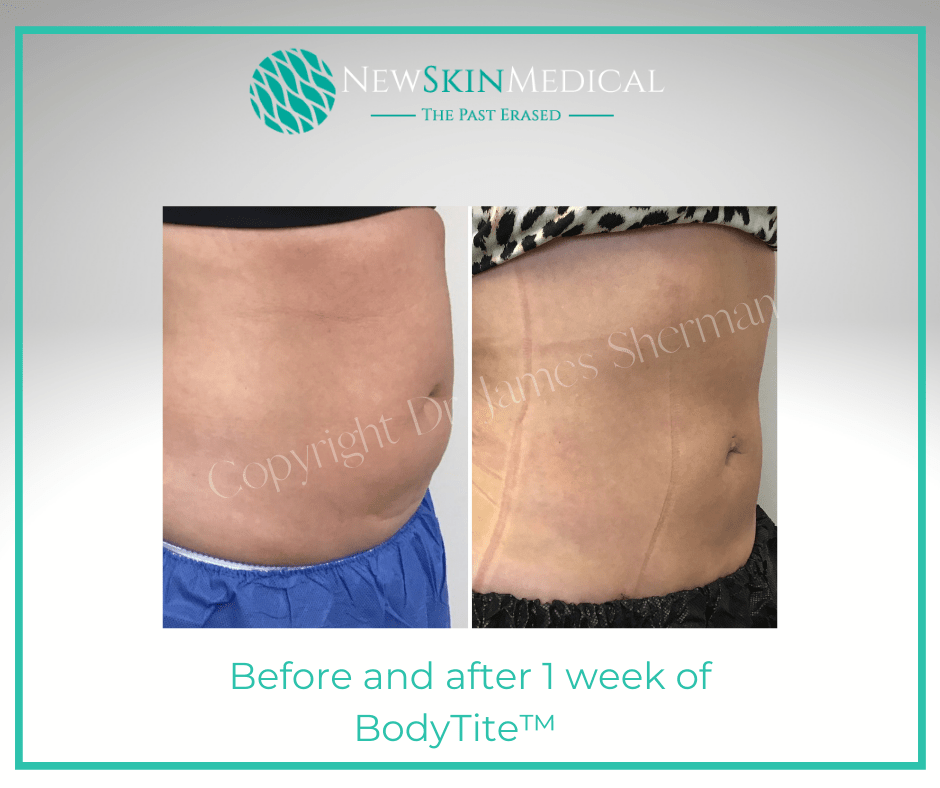 Before and after BodyTIte at New Skin Medical Spa