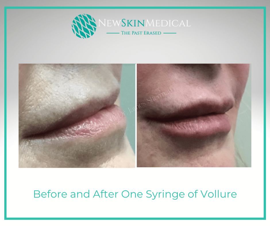 Before and After One Syringe of Vollure with Dr. James Sherman