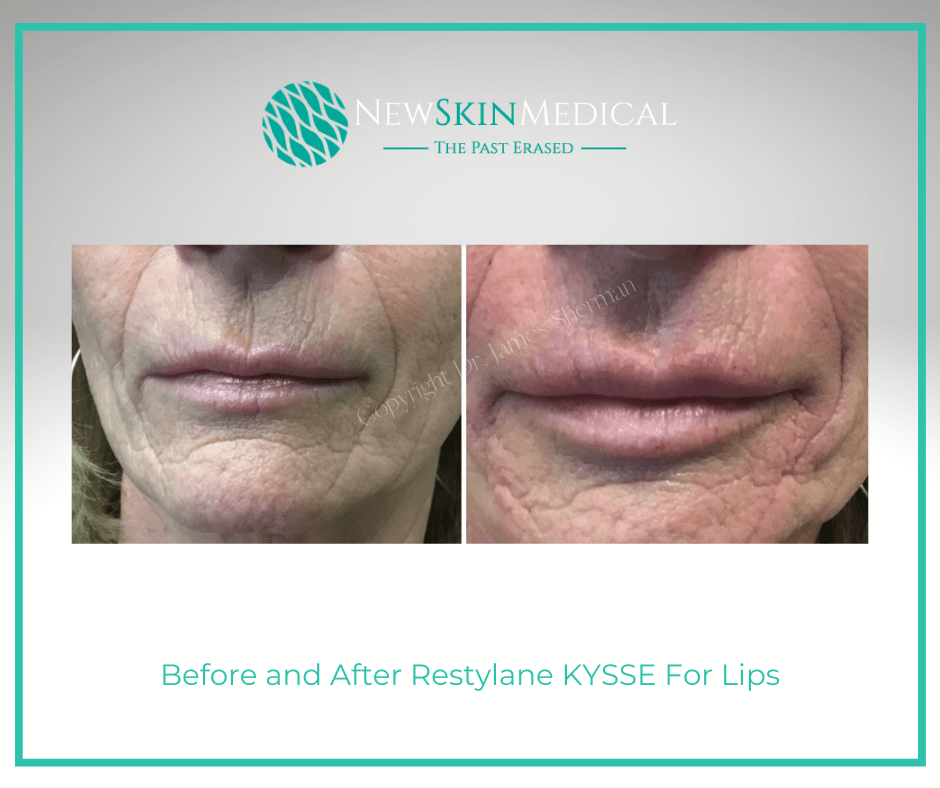 Before and After Restylane KYSSE For Lips with Dr. James Sherman