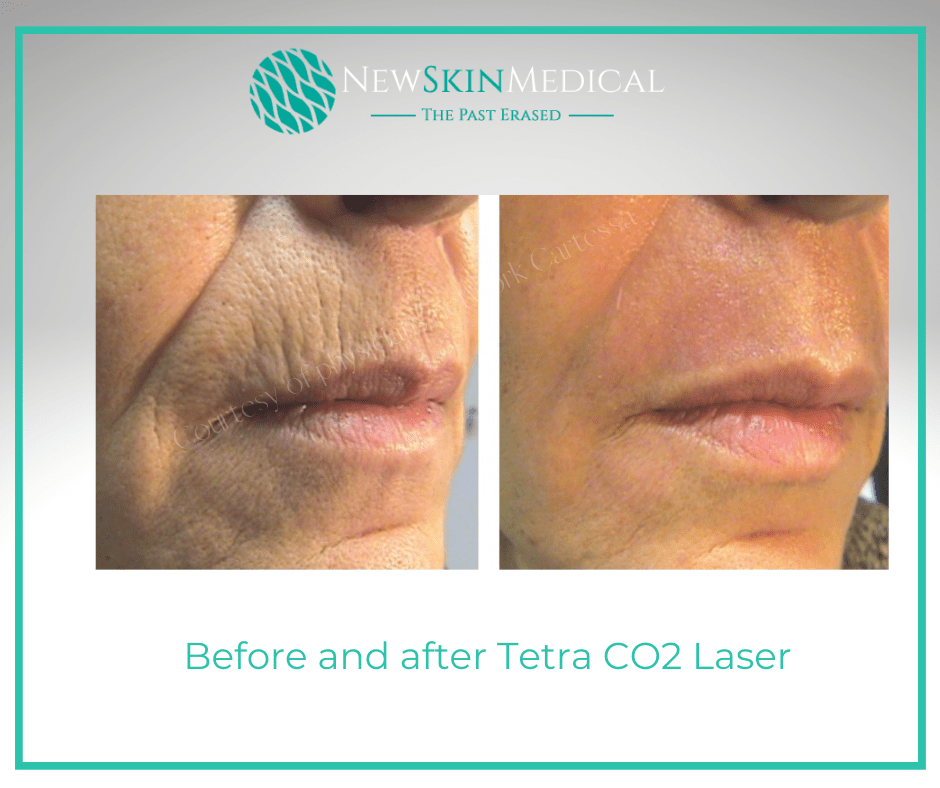 Before and after Tetra CO 2 Laser for Lip Lines