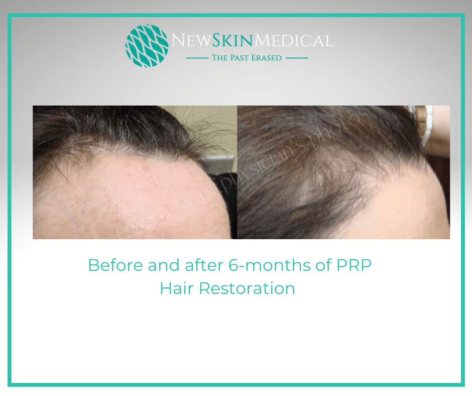 before and after PRP for Hair Loss