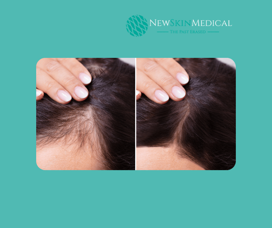 PRP Hair Growth Therapy