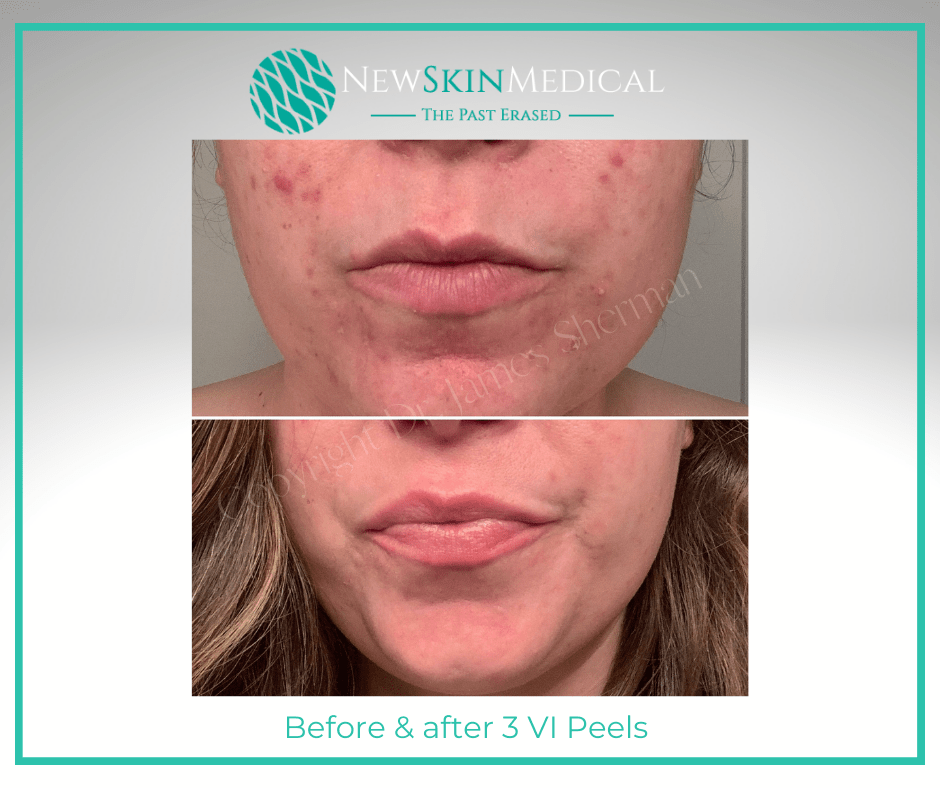 Before & after 3 Vipeels by our talented esthetician Melissa - New Skin Medical Augusta