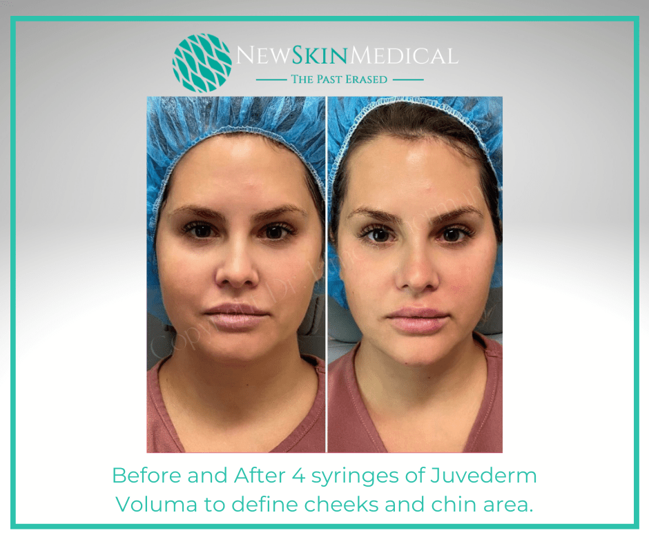 Before and after Filler at New Skin Medical Spa - Enjoy our Before and after gallery