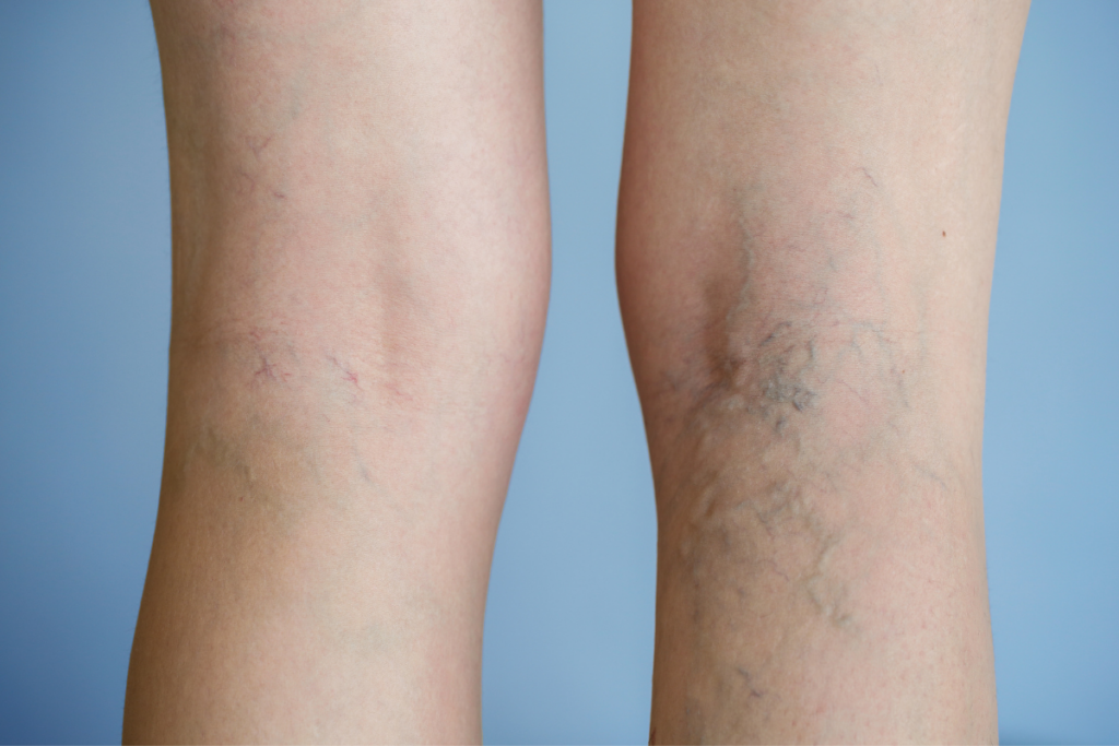 Varicose Vein Treatment in Augusta Georgia (2)