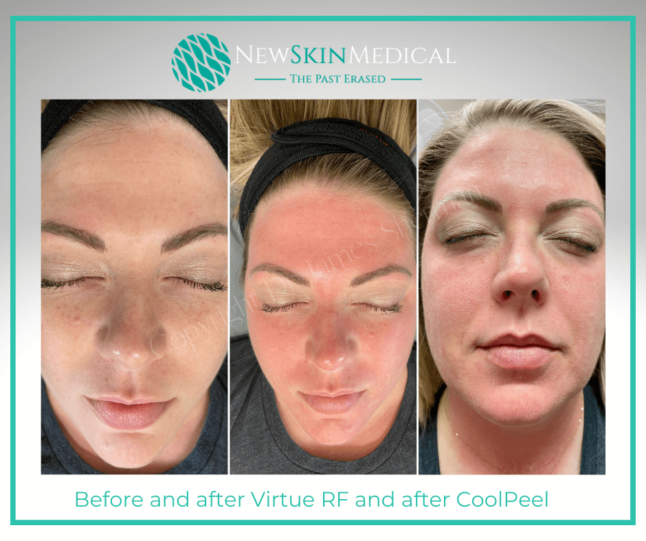 Before and immediately after laser skin rejuvenation