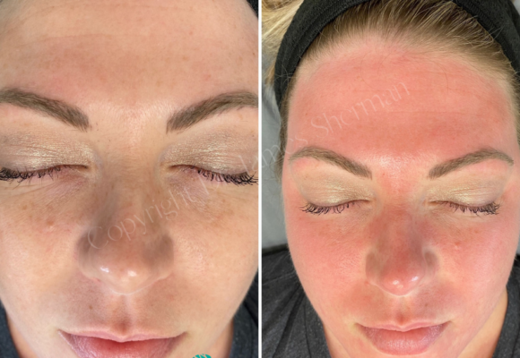 Laser Skin Rejuvenation - Before and after Virtue RF before Cool Peel