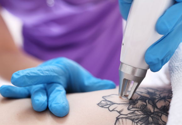 Discovery Pico Tattoo Laser Removal system in action at New Skin Medical Augusta