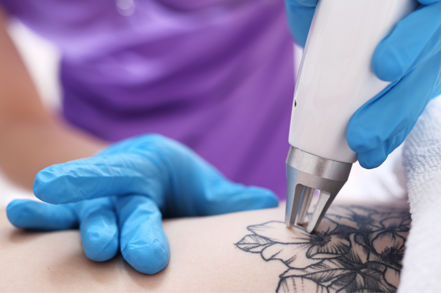 Discovery Pico Tattoo Laser Removal system in action at New Skin Medical Augusta