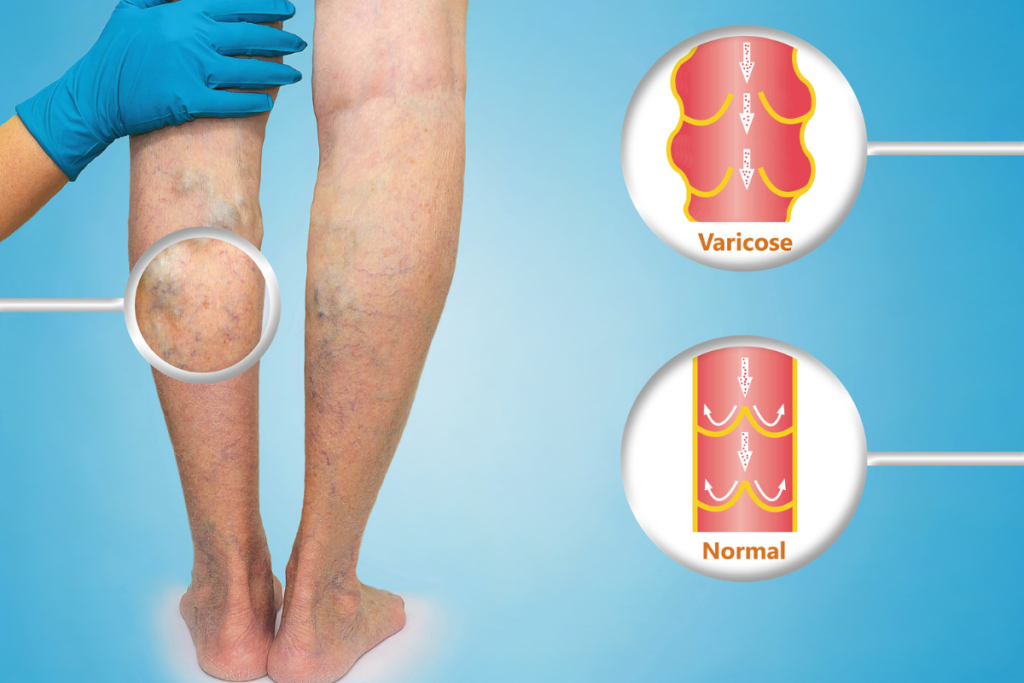 Vein Treatments in Augusta, Georgia