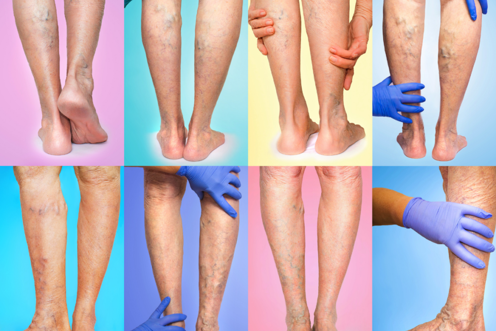 Varicose and Spider Vein Treatments at Vein Specialists of Augusta