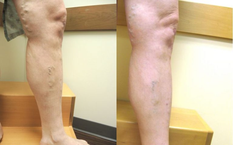 before and after Laser Vein Procedure at Vein Specialists of Augusta