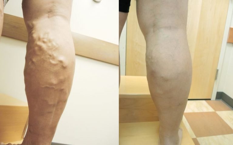 Before and after Laser Vein Procedure by Dr. Sherman 