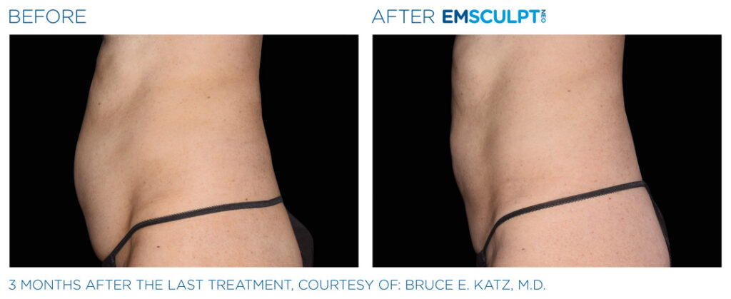 Before and After EMSculpt NEO now available at New Skin Medical