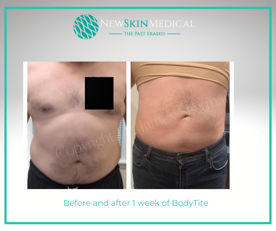 Before and after one week of BodyTite by Dr. Sherman