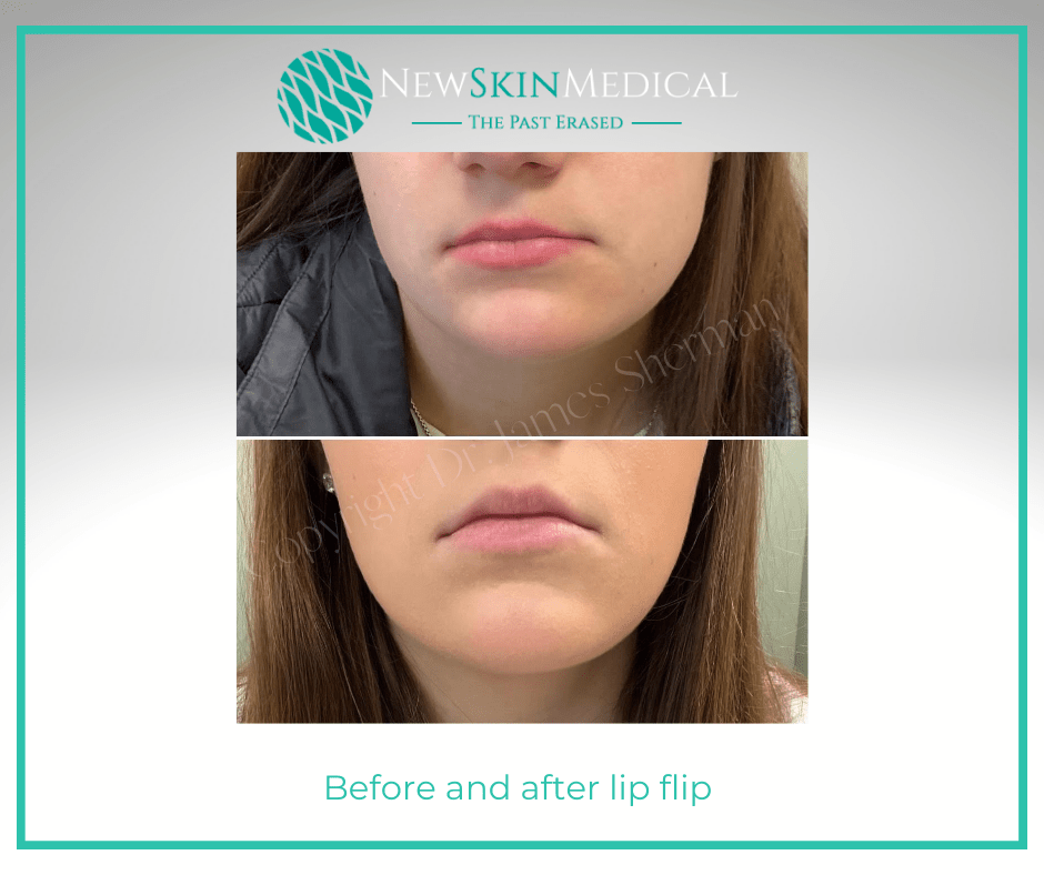 Before and after lip flip by Nurse Erin - New Skin Medical Augusta