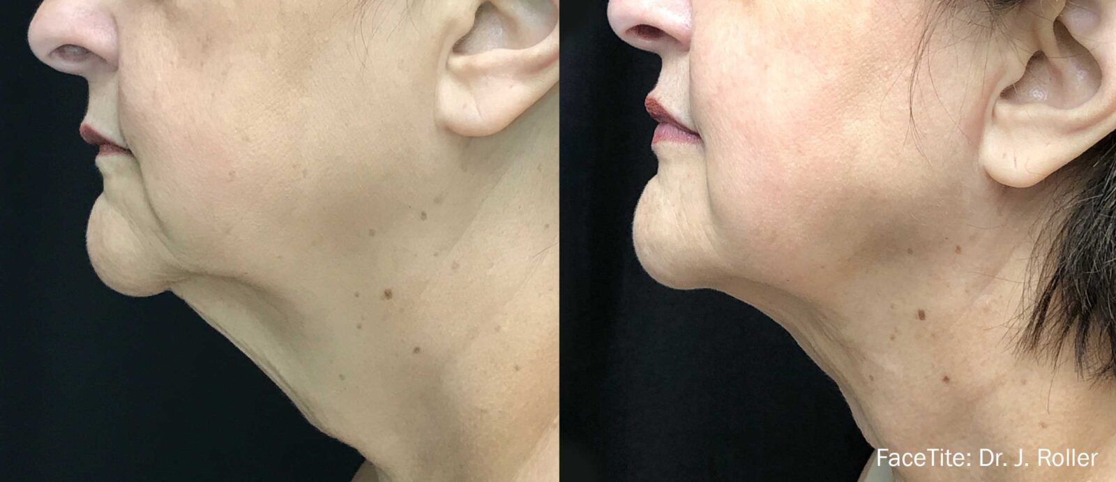 Before and after FaceTite - Image Courtesy of Inmode Provider Network -