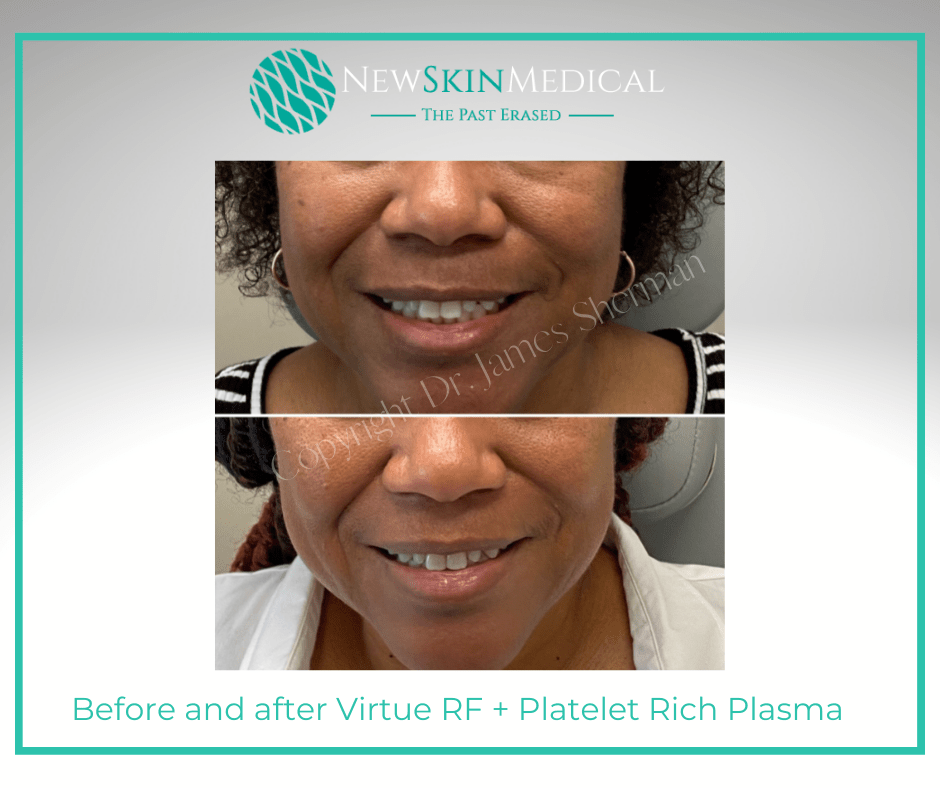 Newskin Medical Spa -Before and after Virtue RF + Platelet Rich Plasma