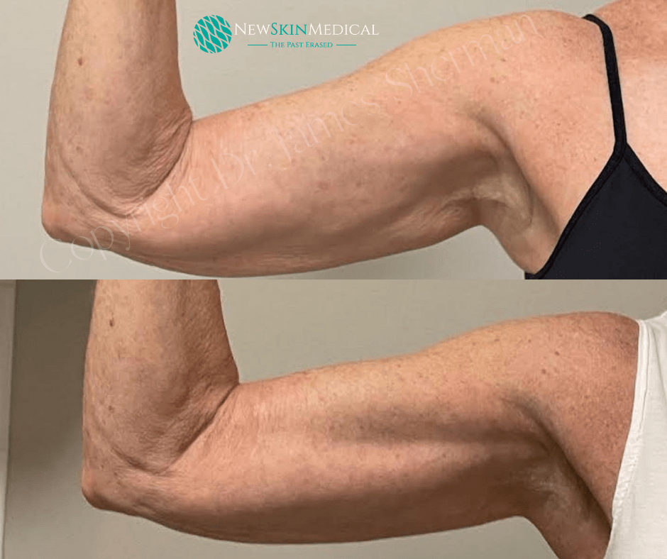 Before and After 4 EMSCULPT NEO Arm treatments  - Newskin Medical Spa (2)