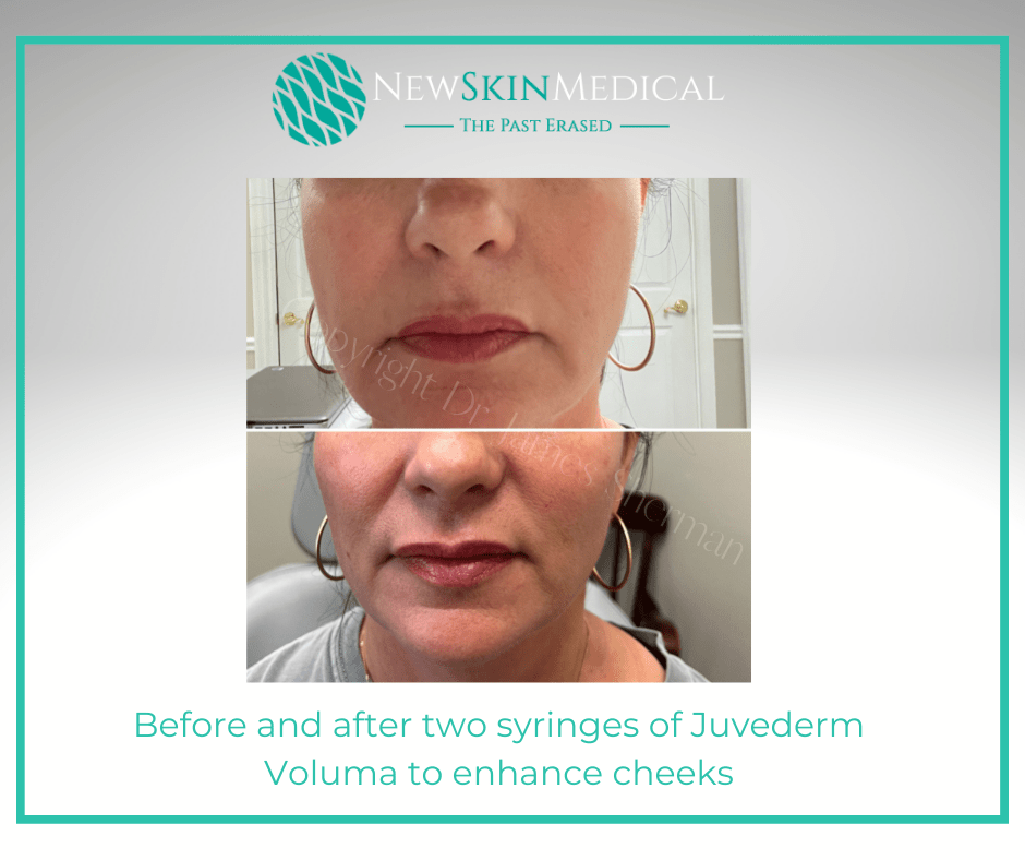 Before and after two syringes of Juvederm Voluma to enhance cheeks -New Skin Medical Spa