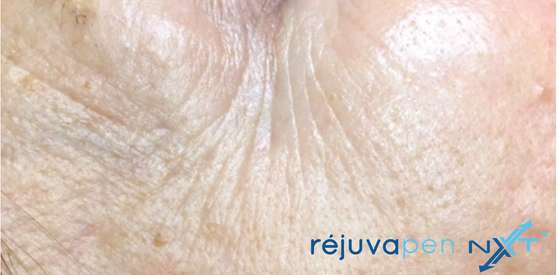 Before Rejuvapen Microneedling