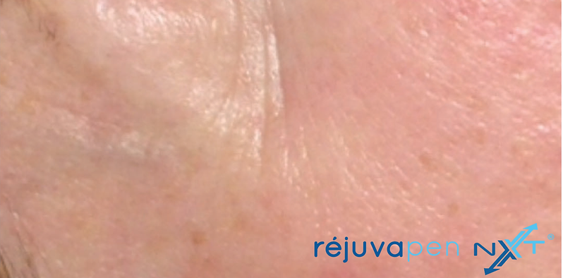 After Rejuva pen Treatment